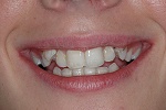 teeth before procedures: correct headaches, migranes, sleep apnea, bruxing and tmj problems with exceptional dental treatment correct sleep apnea, headaches, migranes, bruxing and tmj problems
